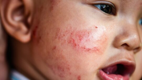A baby suffering from Eczema