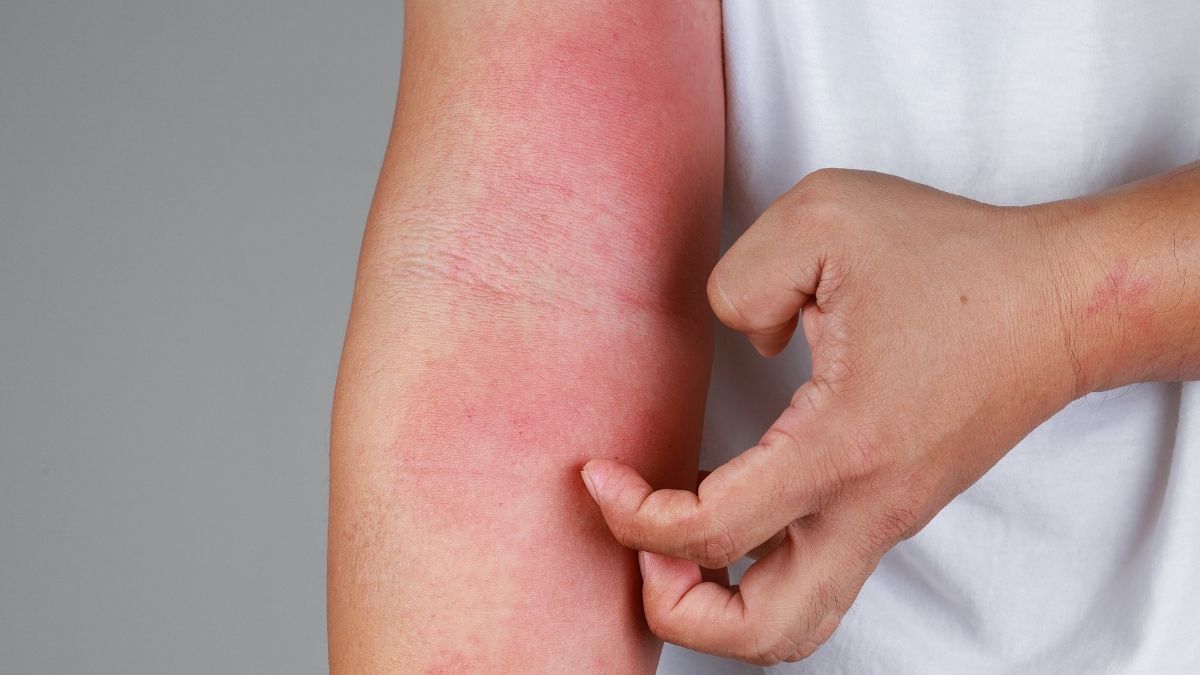 A person scratching their hand cause of irritation from eczema