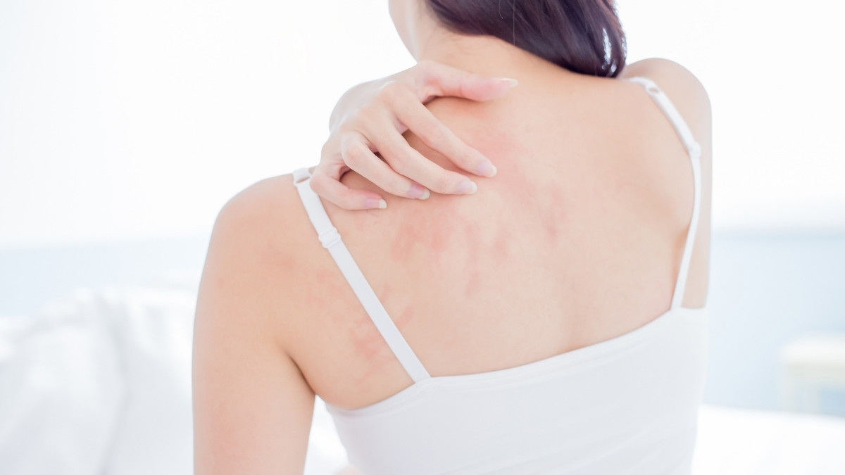 Back of the woman suffering from eczema