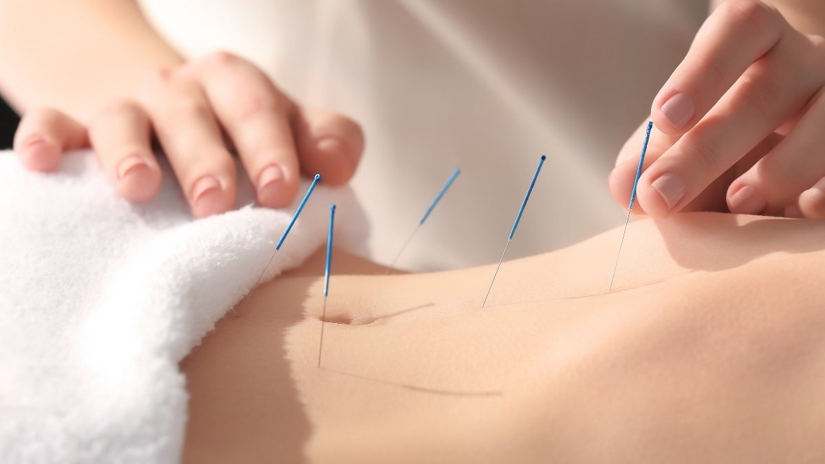 A lady getting an acupressure session