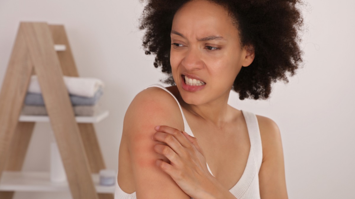A girl with Eczema