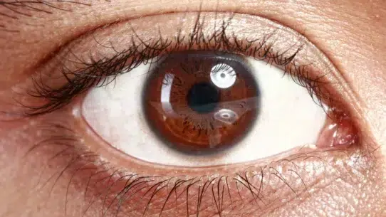 Normal Tension Glaucoma