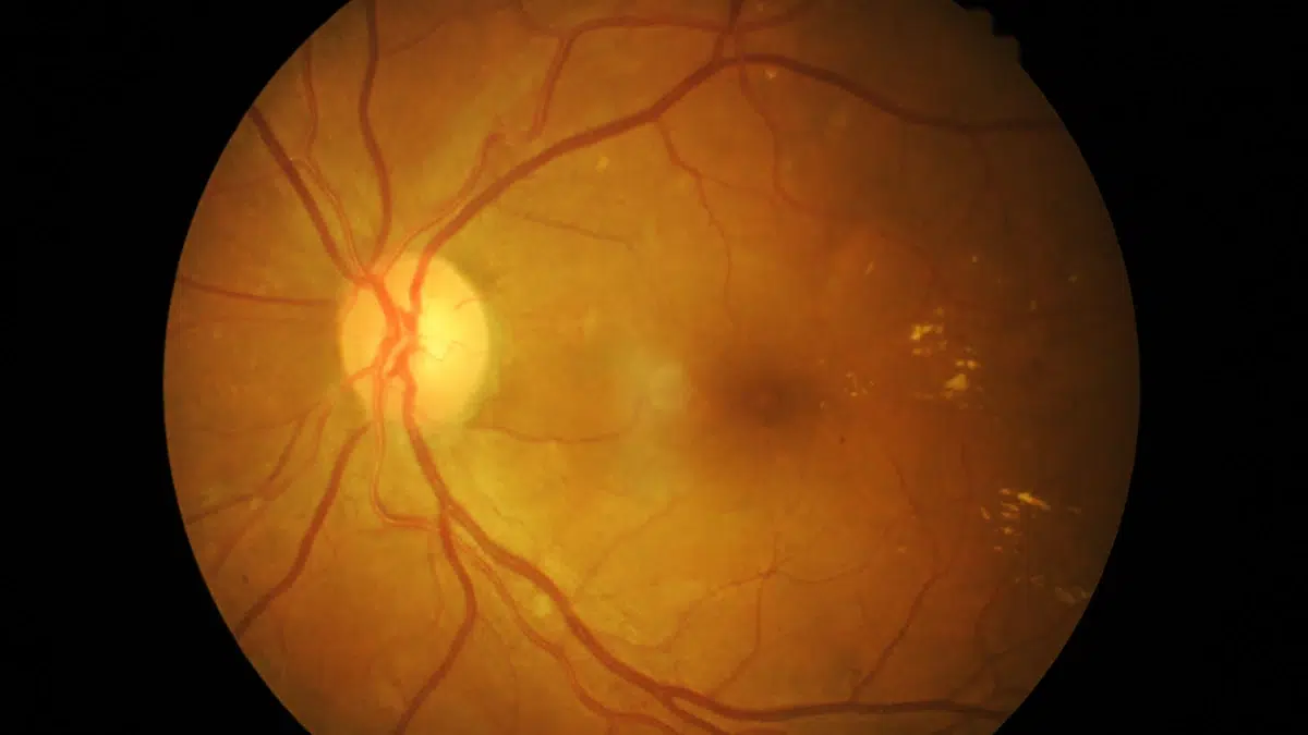 can dry eyes cause vitreous detachment