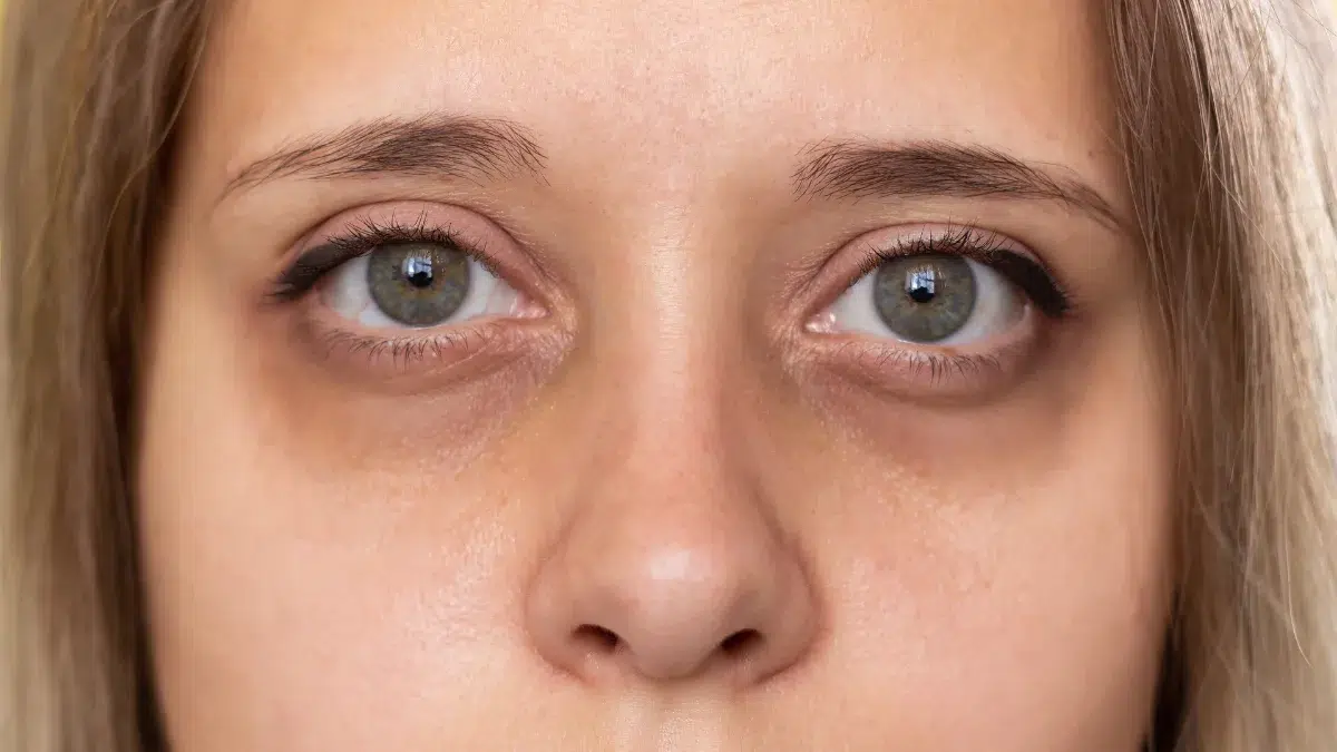 Bimatoprost Side Effects