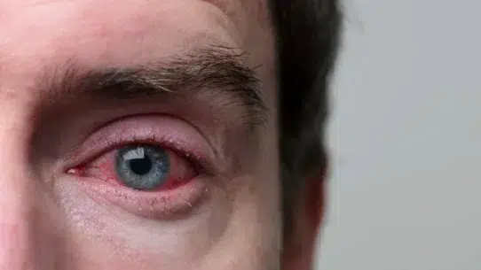 dry eye allergy
