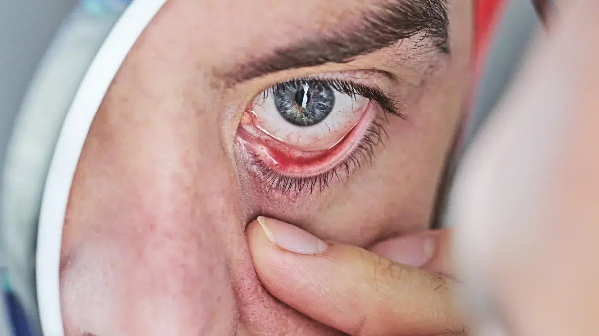 dry eye medication