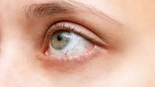 dry eye treatment