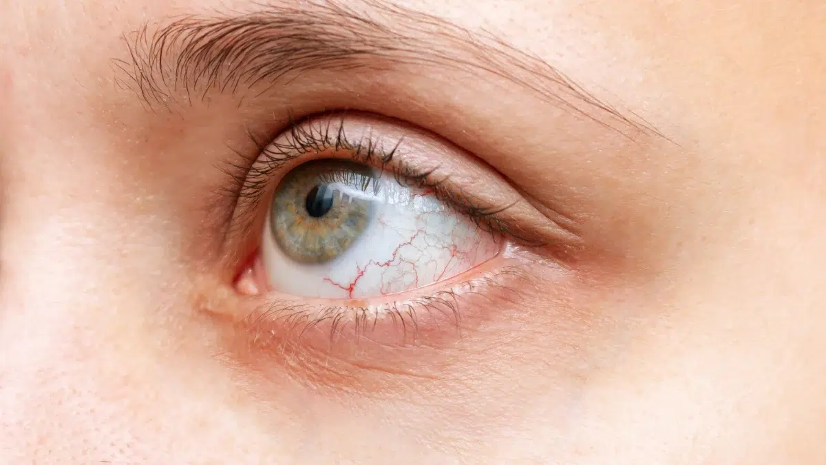 dry eye treatment
