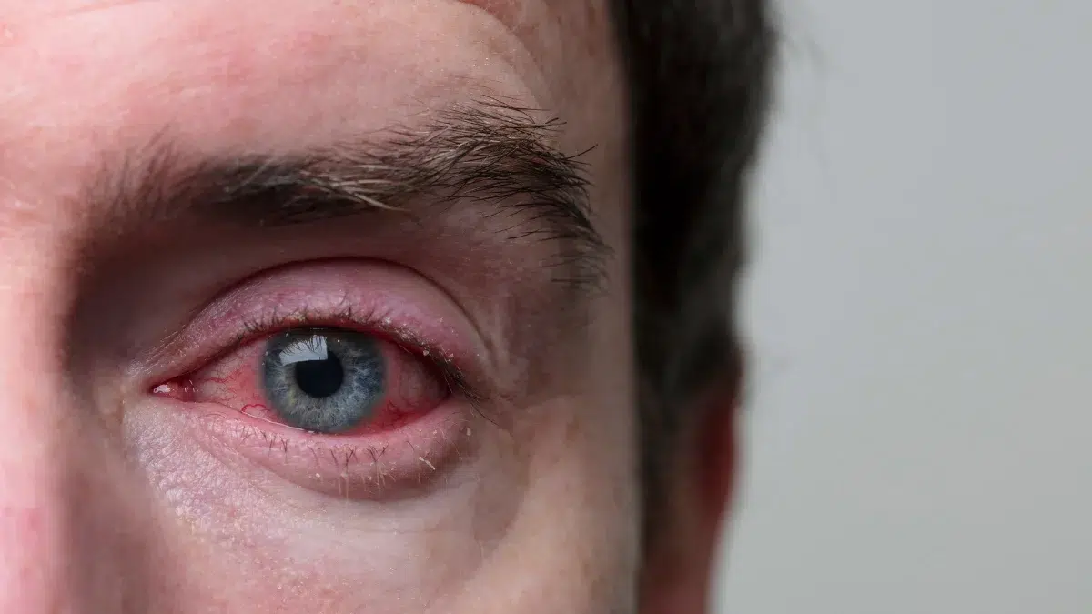 pink eye treatment