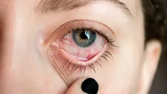 pink eye home remedies