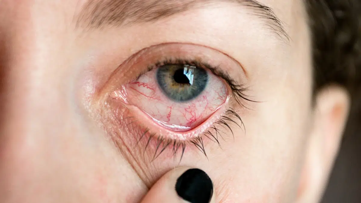 pink eye home remedies