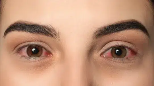 pink eye medicine