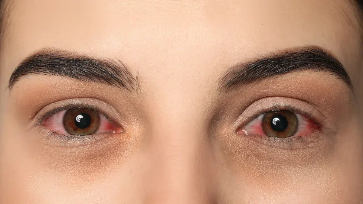 pink eye medicine