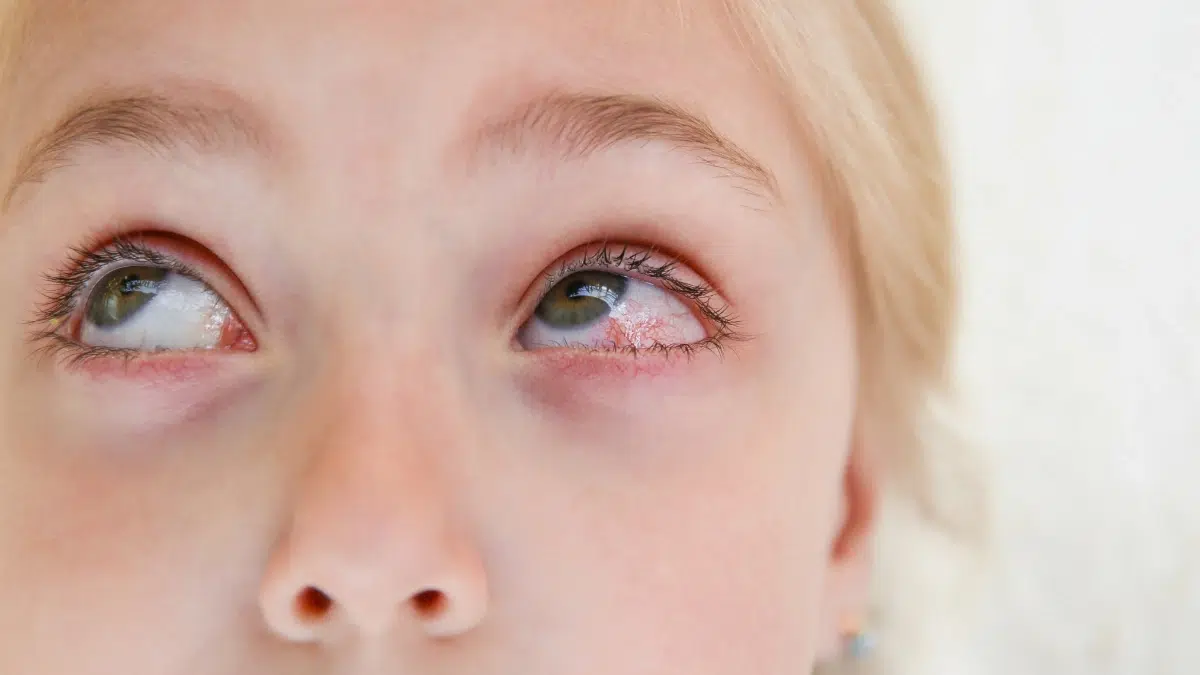 viral pink eye remedy