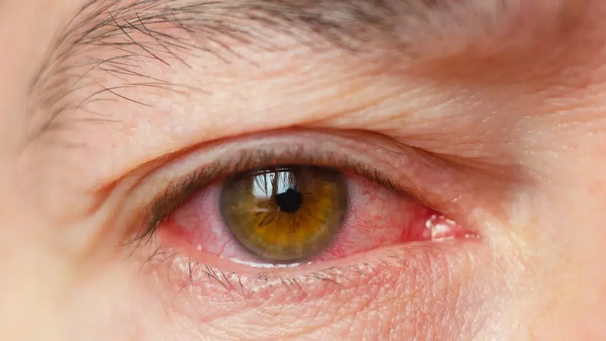 viral pink eye symptoms