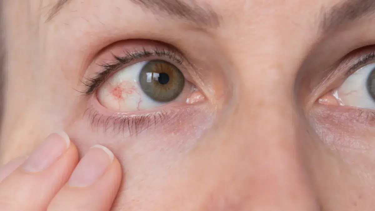 vitamins to reduce eye pressure