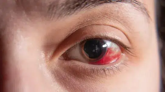 Exposure Keratitis