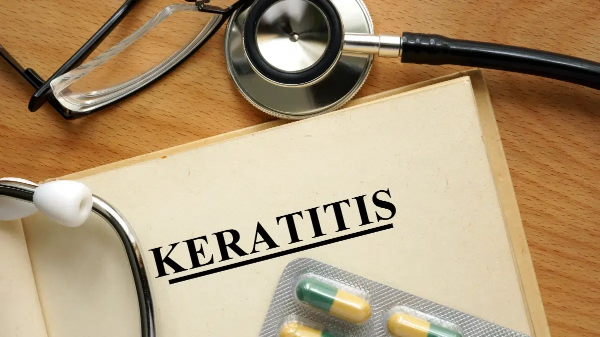 Symptoms of Keratitis