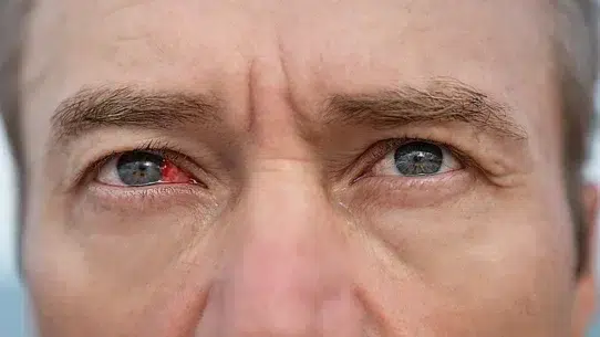 types of Eye Infection
