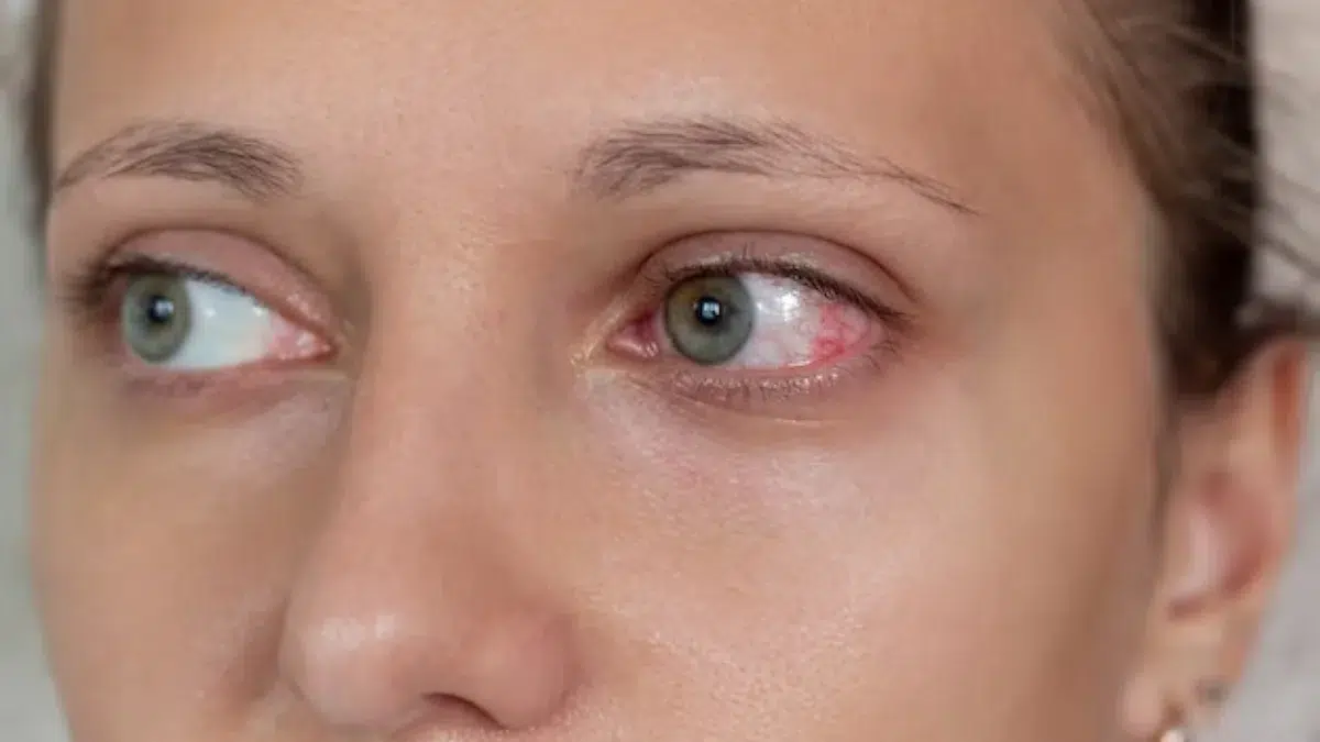 Uveitis