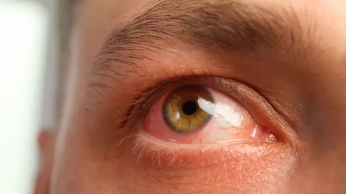 antibiotics for eye infection