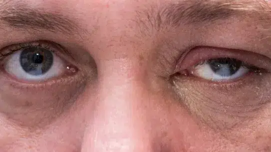 does pink eye cause swelling