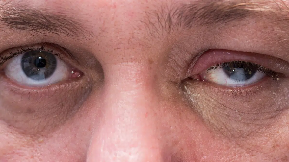 does pink eye cause swelling