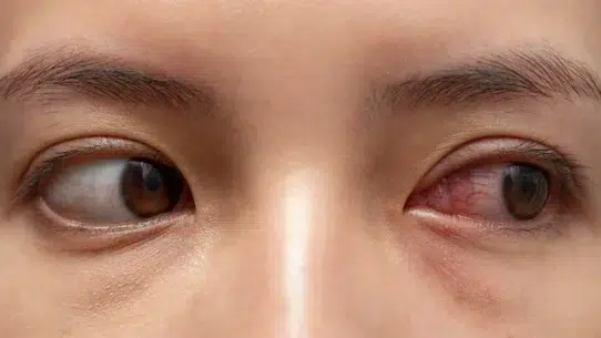 eye redness and pain