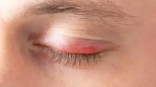 eye swollen and red