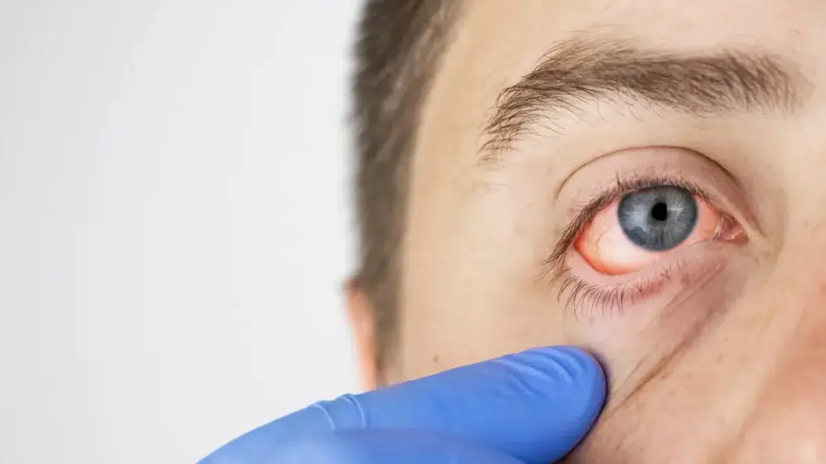 how long does pink eye last