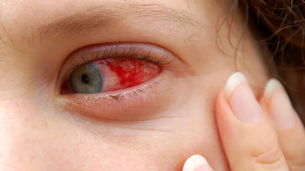 how long is pink eye contagious