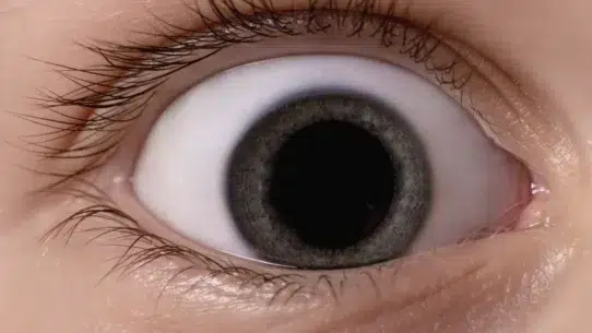 interstitial keratitis