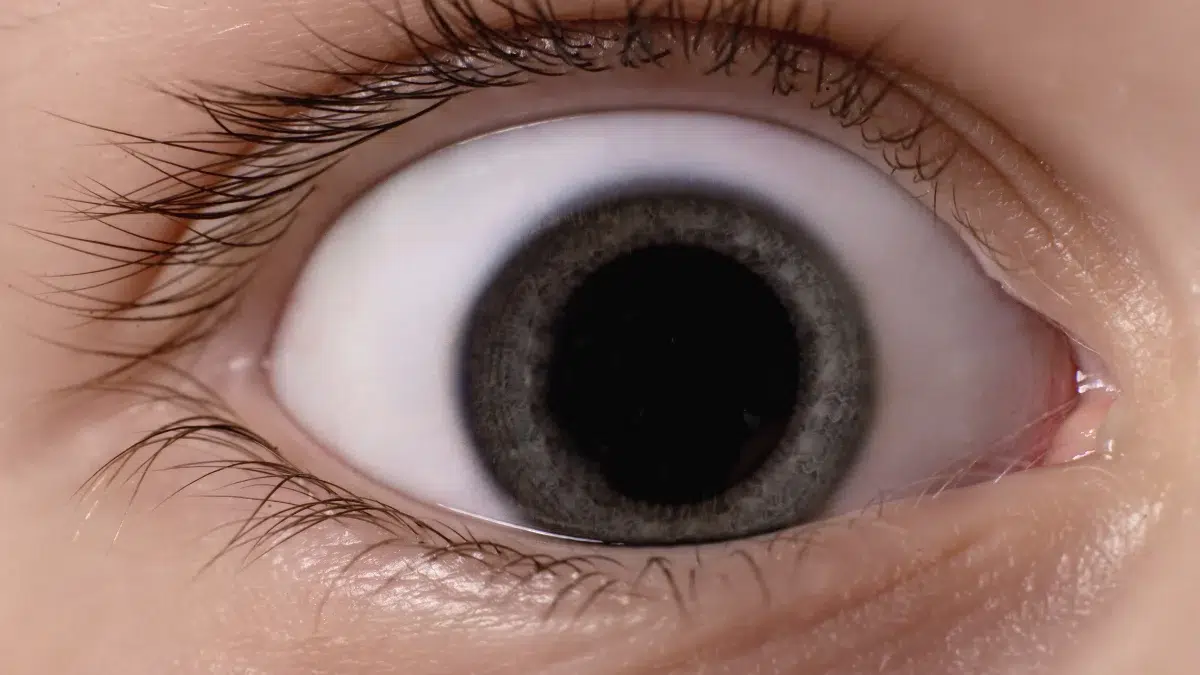interstitial keratitis