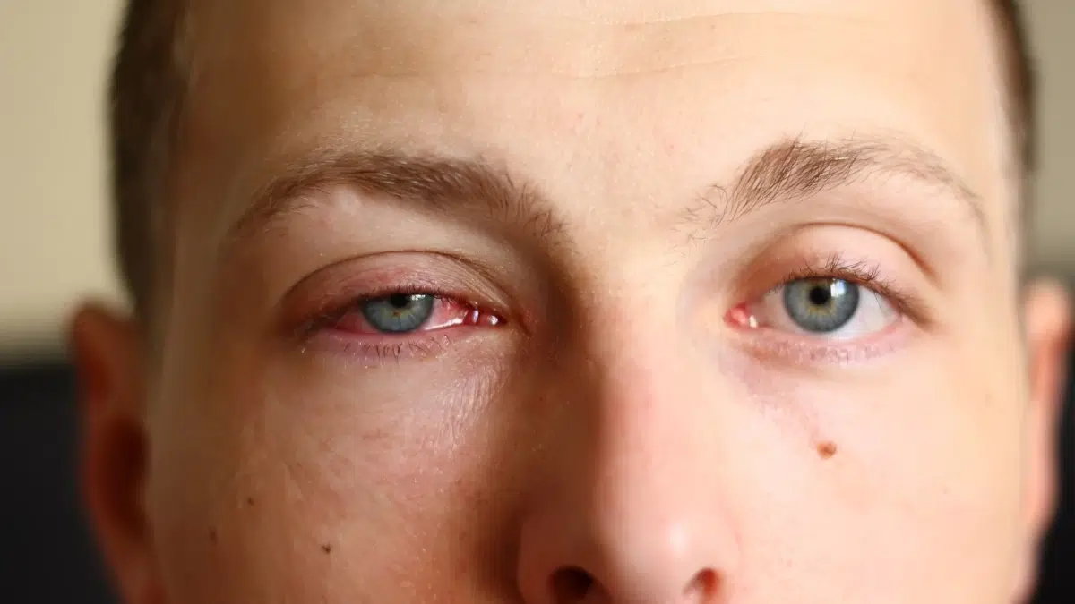 is pink eye dangerous