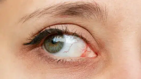 keratitis causes