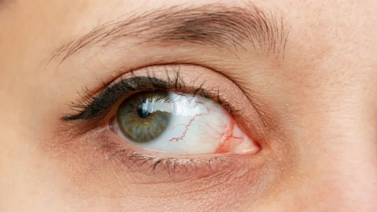 keratitis causes