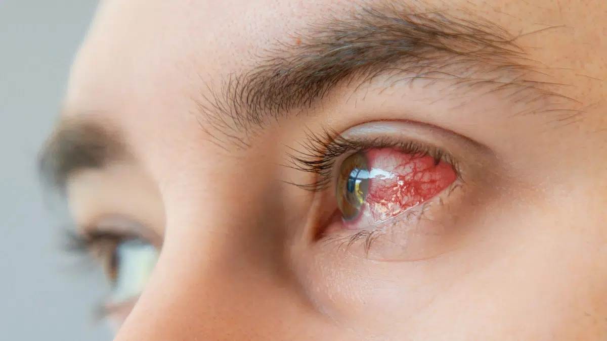 keratitis vs uveitis