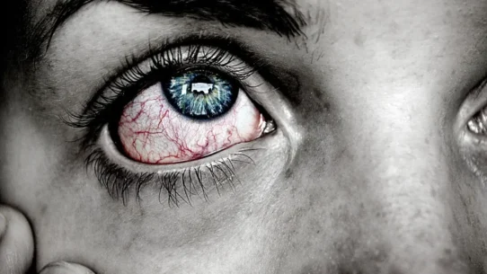 neurotrophic keratitis