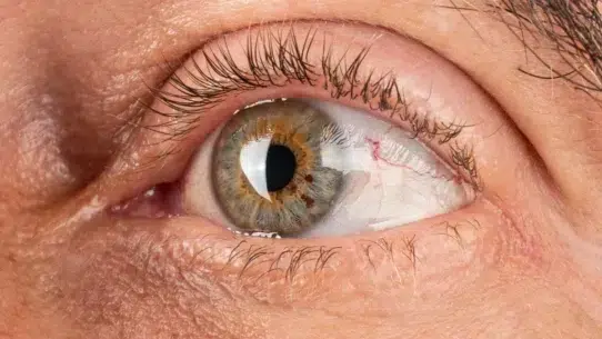peripheral ulcerative keratitis