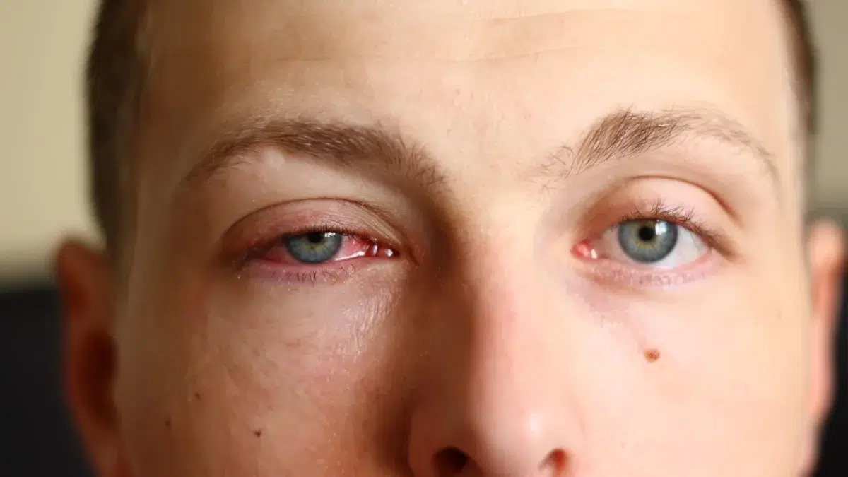 pink eye
