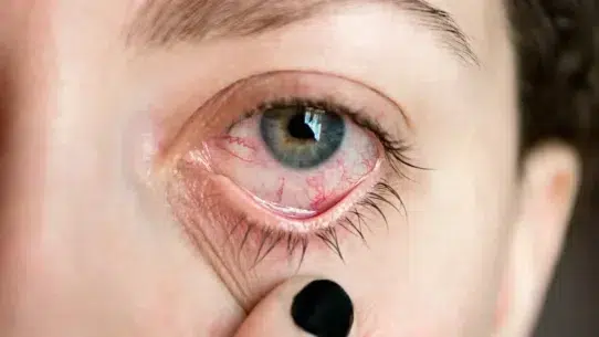 red itchy eyes