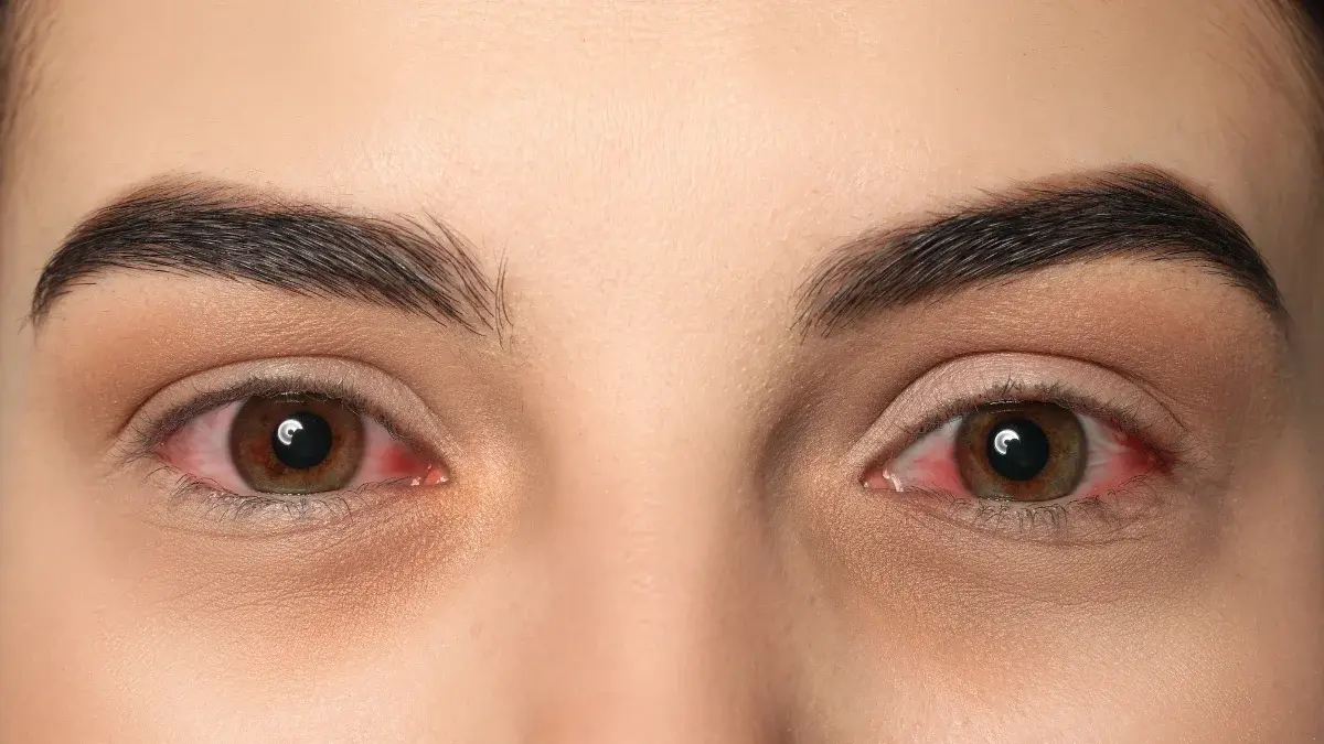 how to get rid of red eyes without eye drops