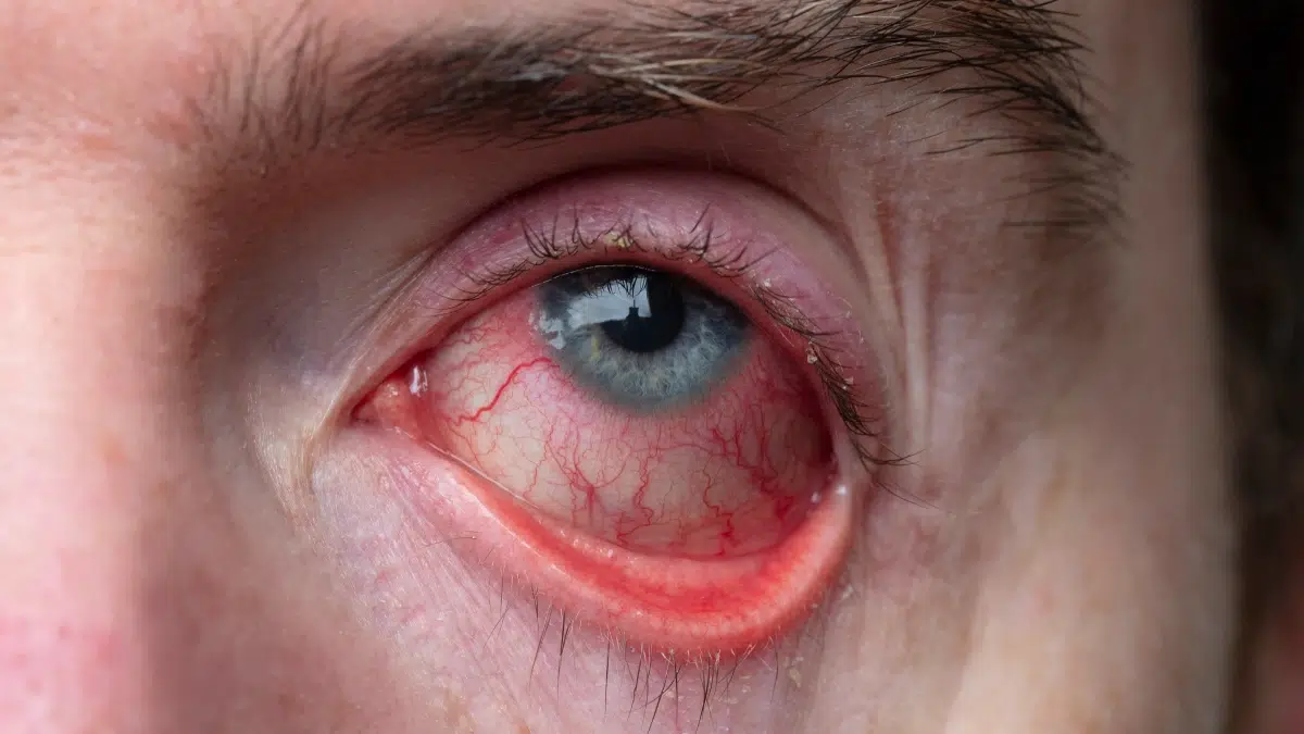 uveitis medication
