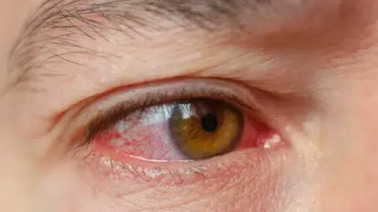 why are my eyes red