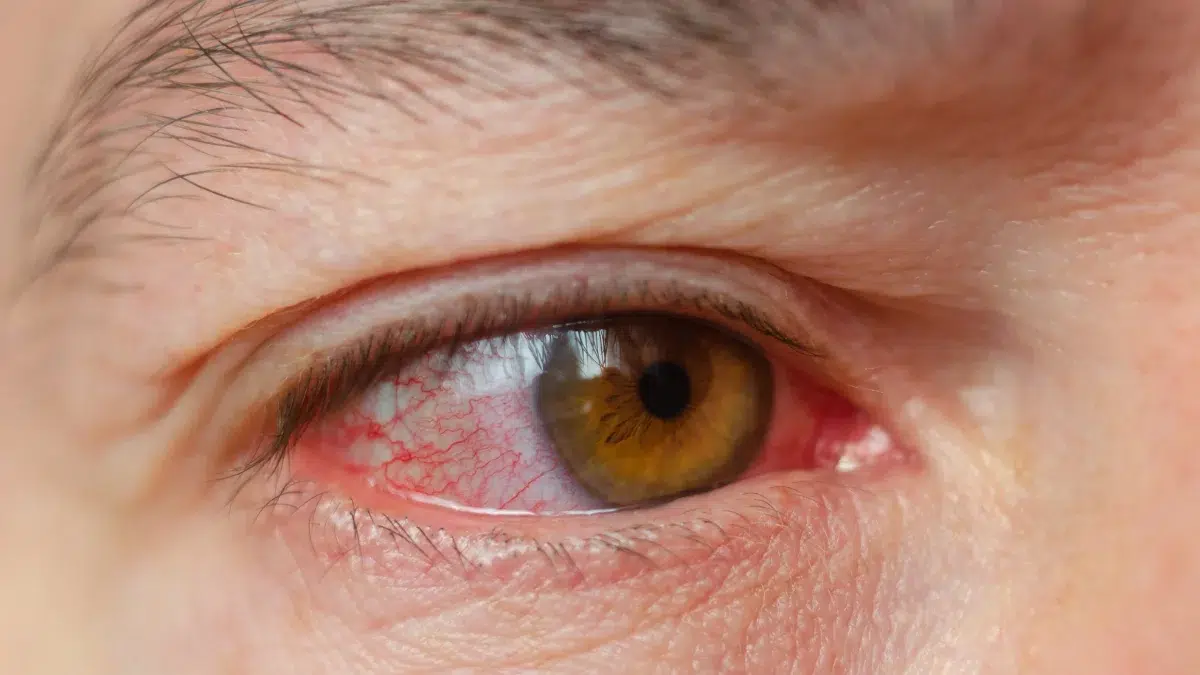 why are my eyes red