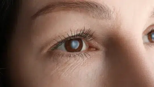 average age for cataract surgery