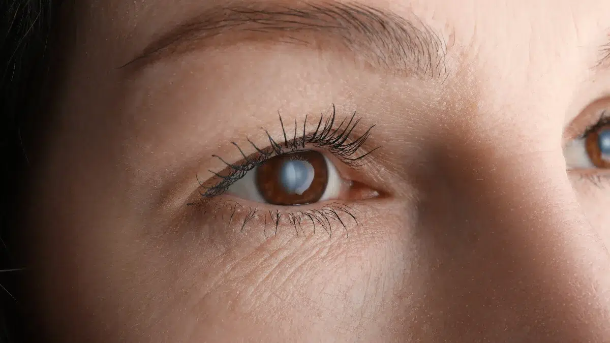 average age for cataract surgery