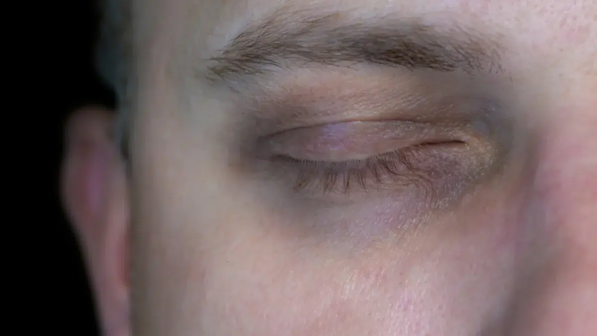 home remedies for bags under eyes