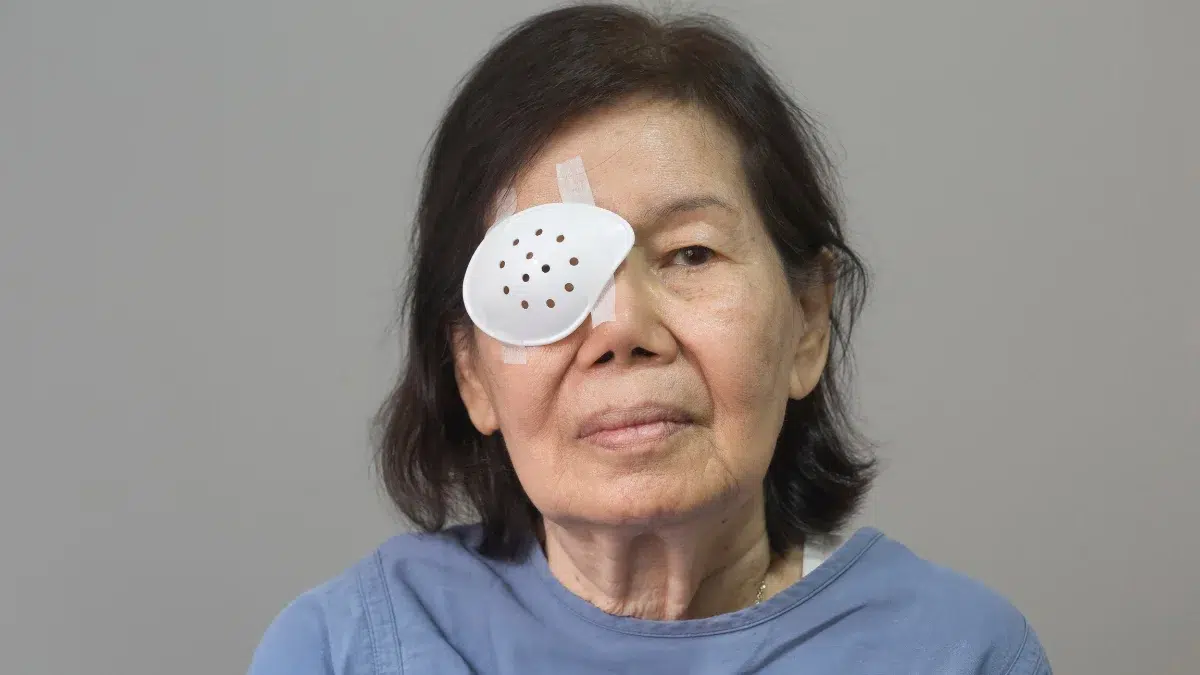 extracapsular cataract extraction