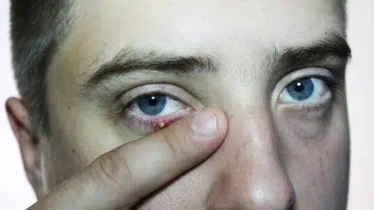 discharge from eye allergies